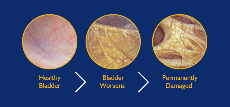 Bladder Progression 2023 no citation numbers